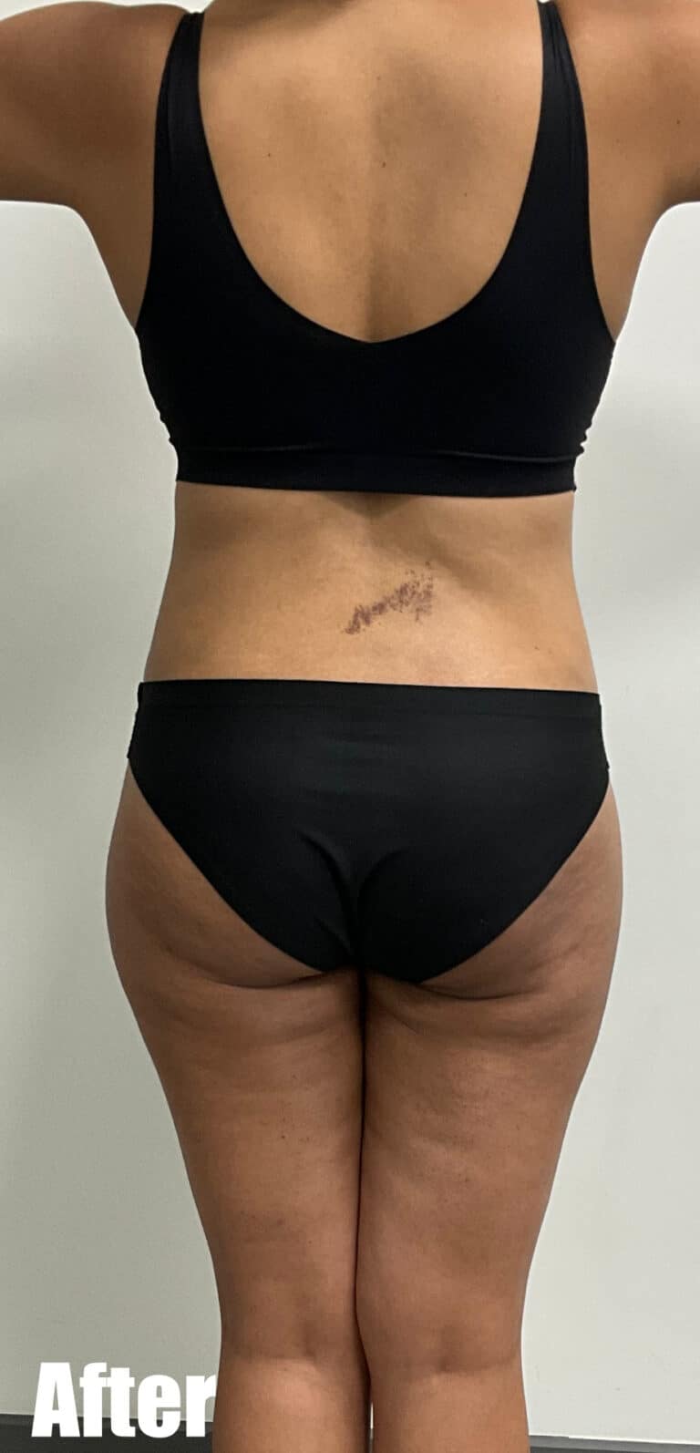 After Image: Circumferential Tummy Tuck - back