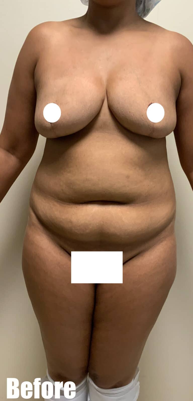 Before Image: Circumferential Tummy Tuck - front