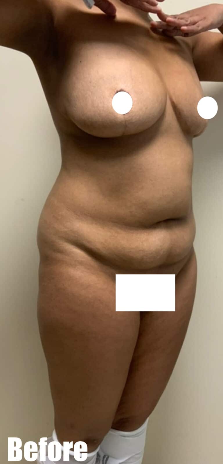 Before Image: Circumferential Tummy Tuck - right-front-oblique