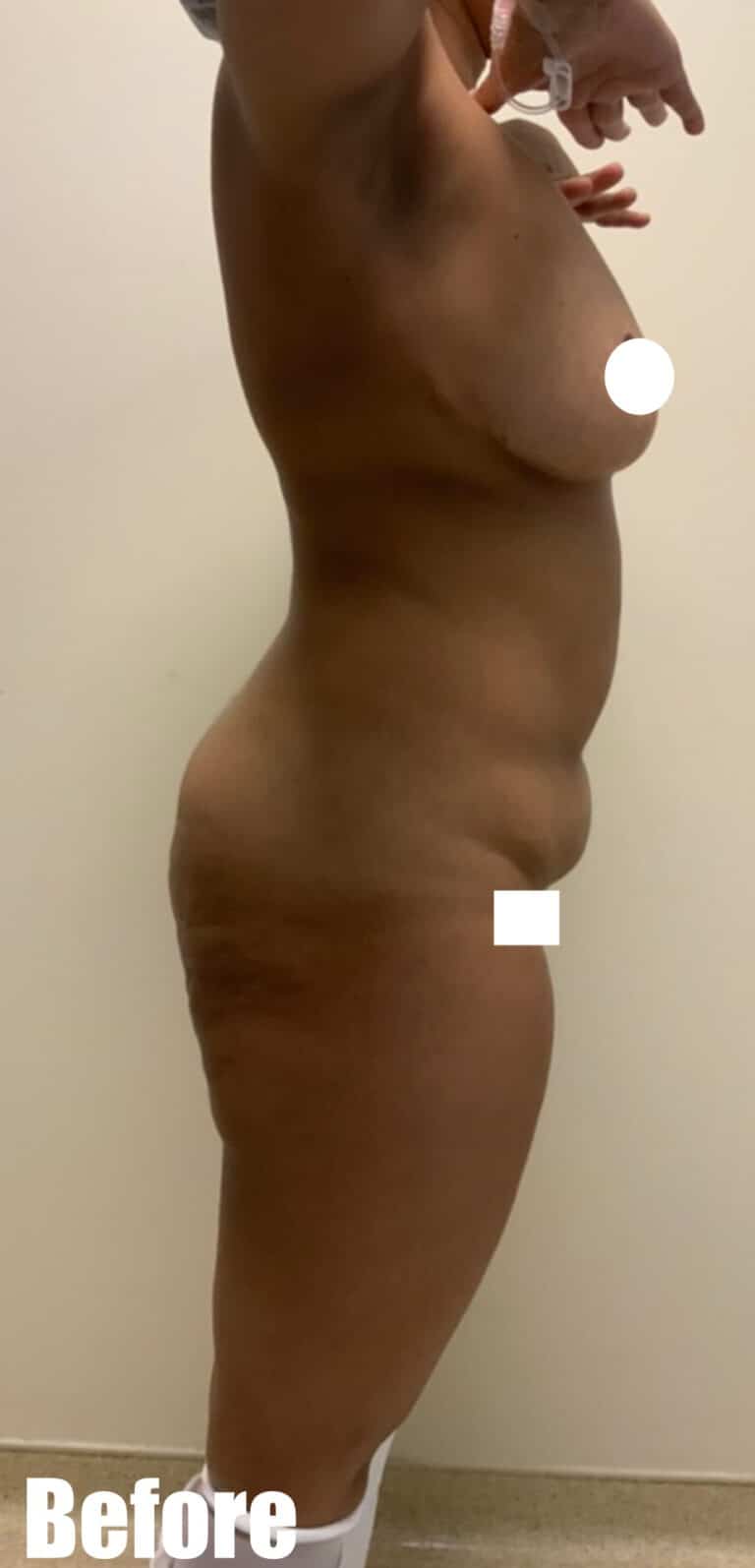 Before Image: Circumferential Tummy Tuck - right-side