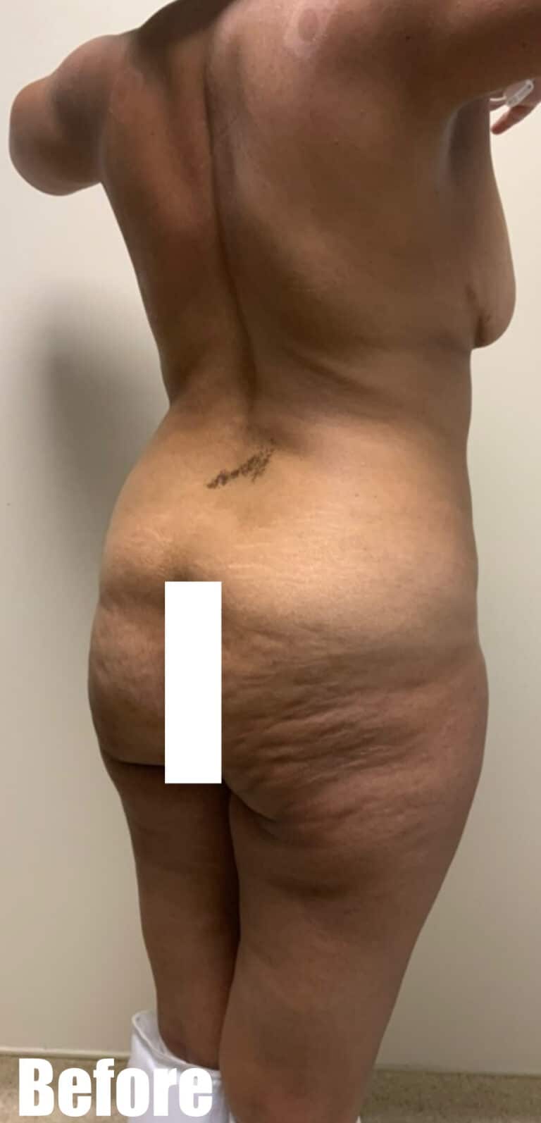 Before Image: Circumferential Tummy Tuck - right-back-oblique