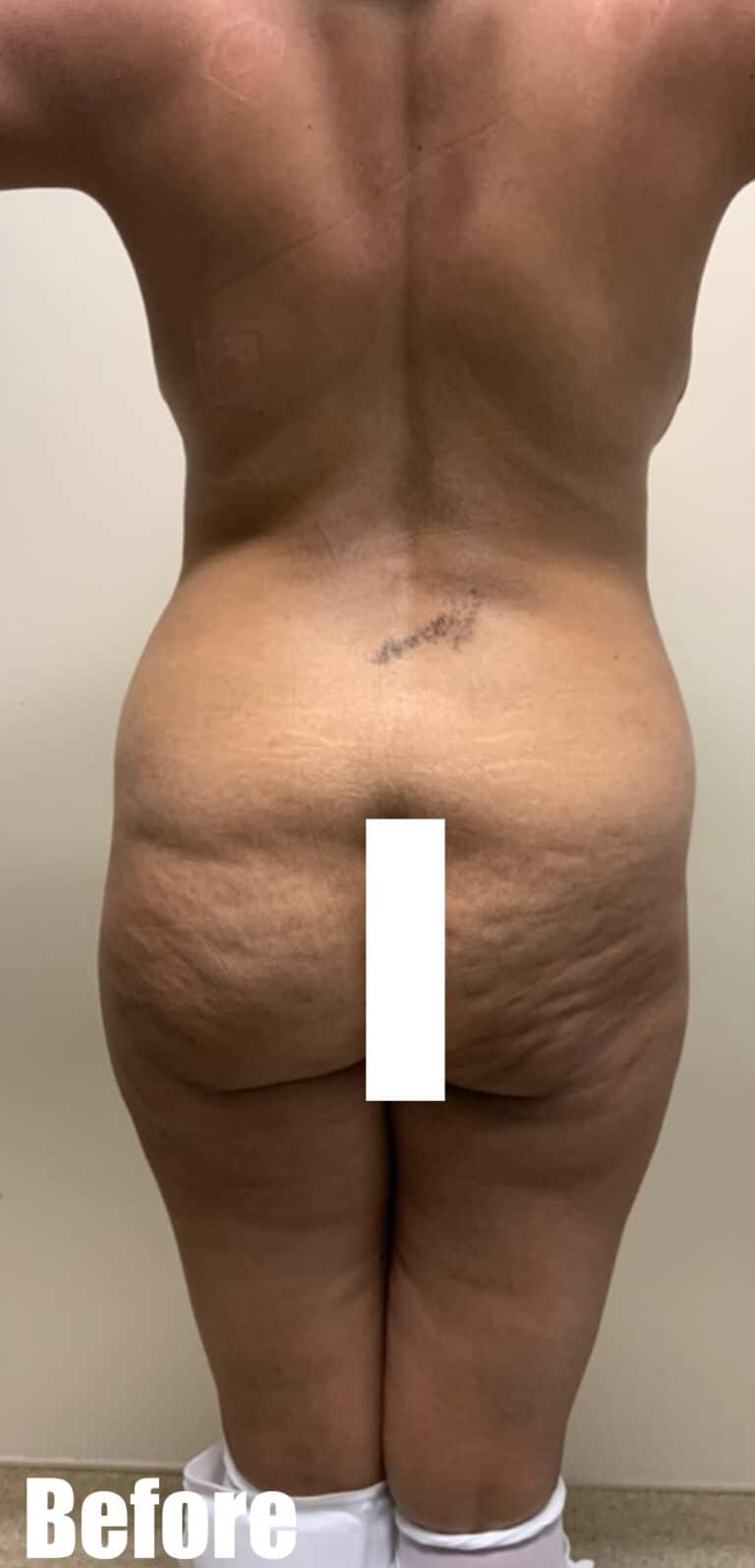 Before Image: Circumferential Tummy Tuck - back