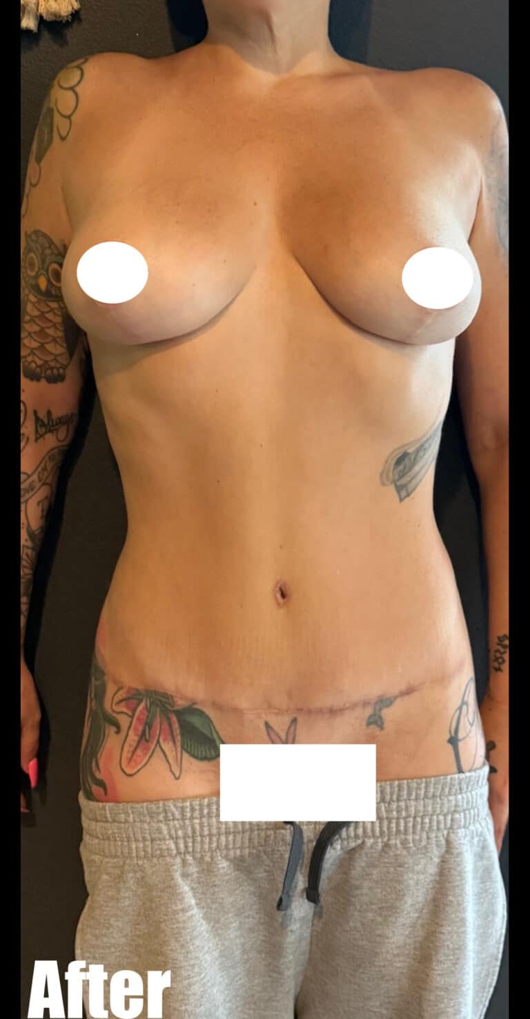 After Image: Mommy Makeover - front