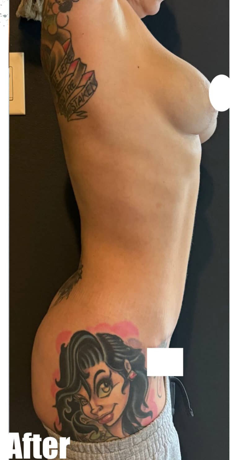 After Image: Mommy Makeover - right-side