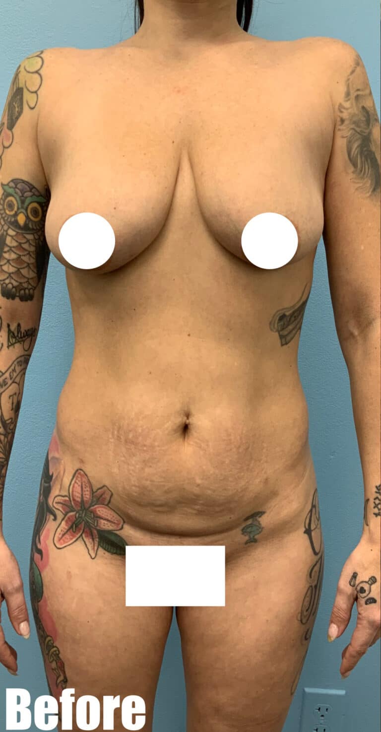 Before Image: Mommy Makeover - front