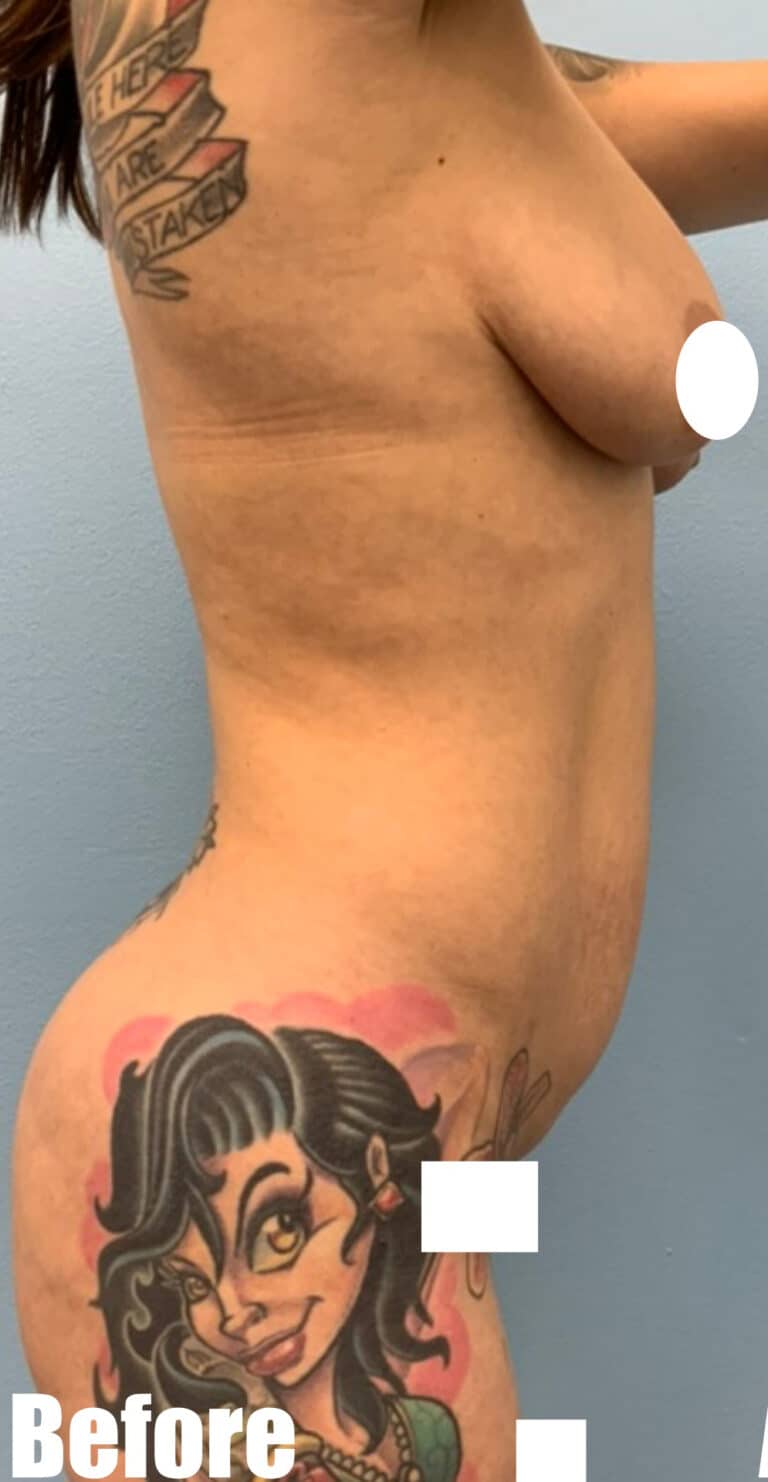 Before Image: Mommy Makeover - right-side