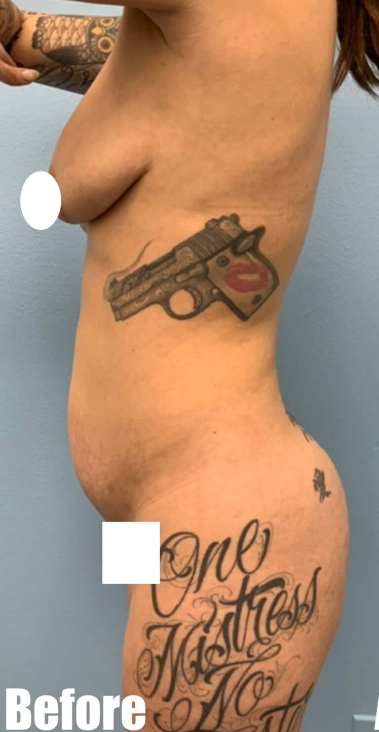 Before Image: Mommy Makeover - left-side