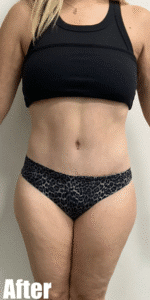 After Image: Tummy Tuck