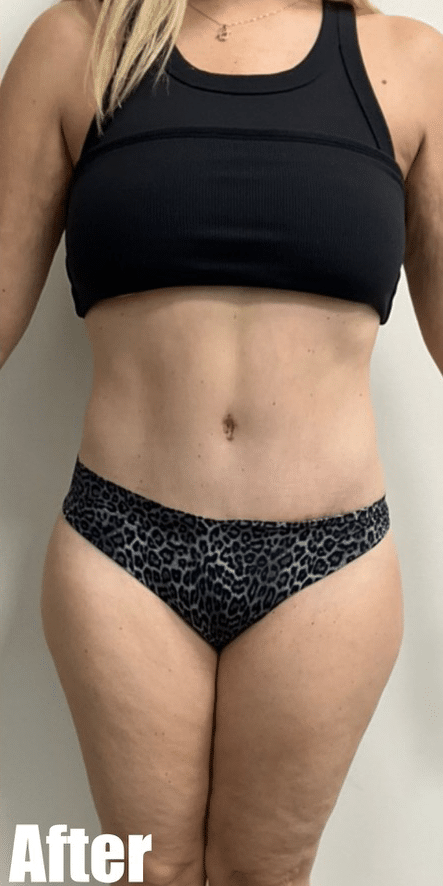 After Image: Tummy Tuck - front