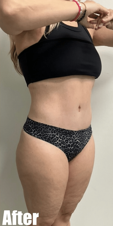 After Image: Tummy Tuck - right-front-oblique