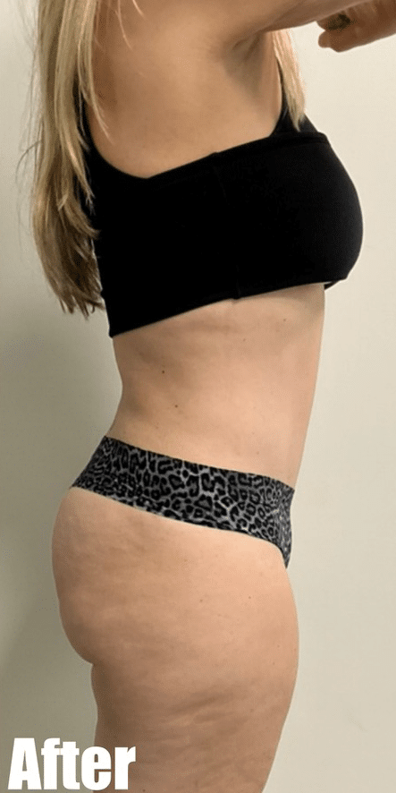 After Image: Tummy Tuck - right-side