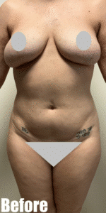 Before Image: Tummy Tuck