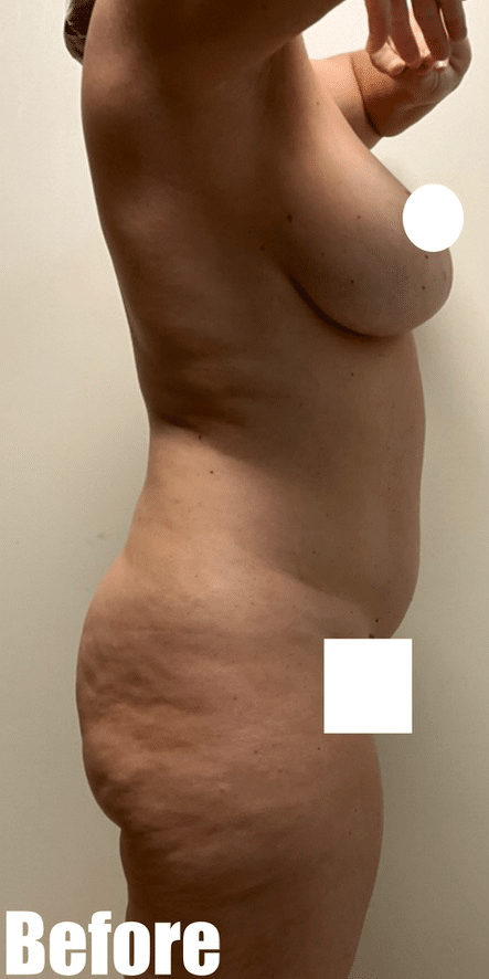 Before Image: Tummy Tuck - right-side