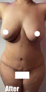 After Image: Breast Reduction