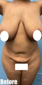 Before Image: Breast Reduction