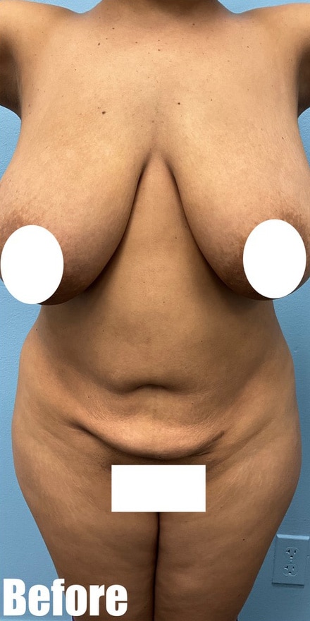 Before Image: Breast Reduction - front