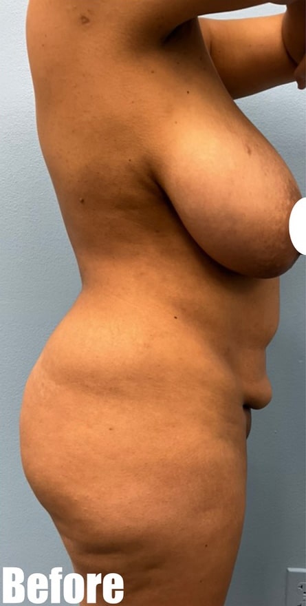 Before Image: Breast Reduction - right-side