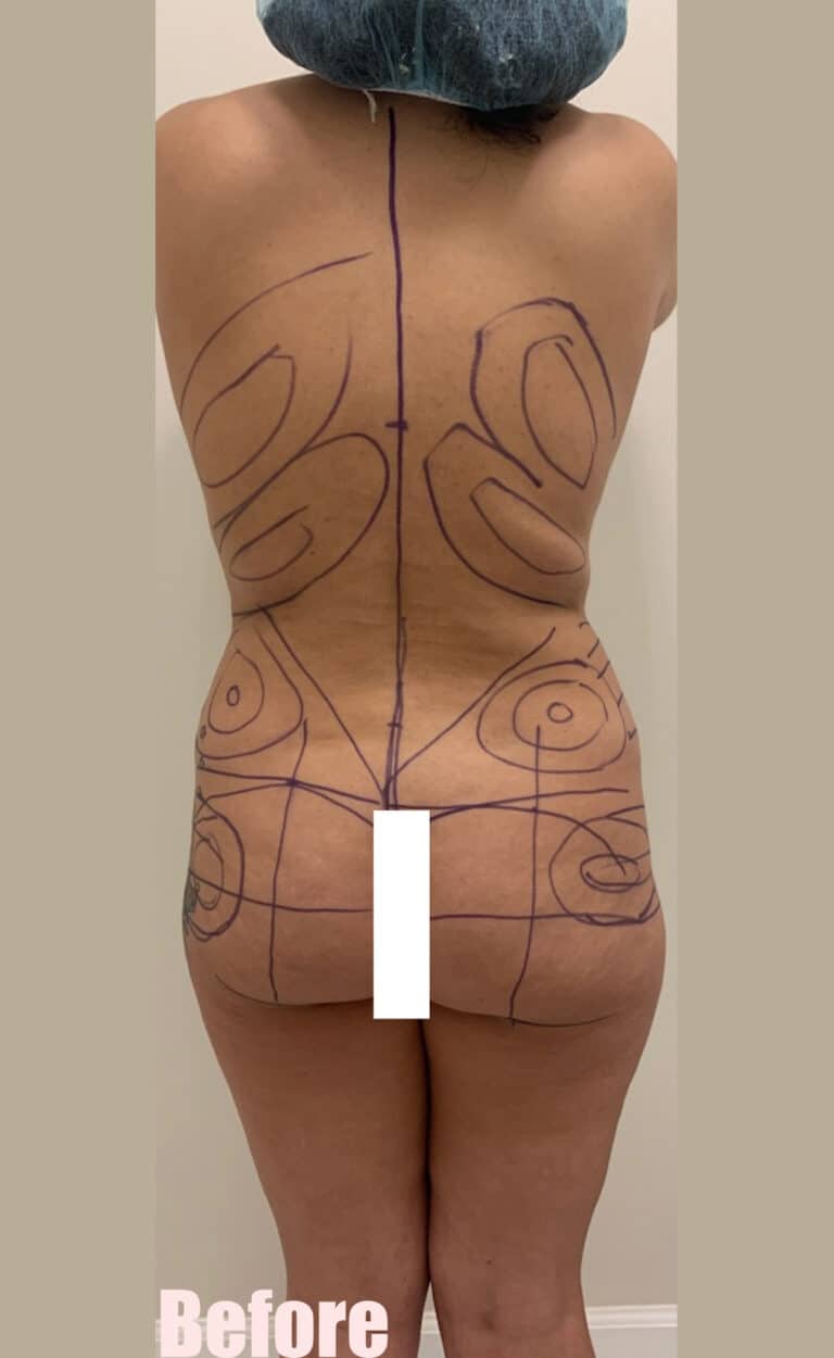 Before Image: Brazilian Buttock Lift - back