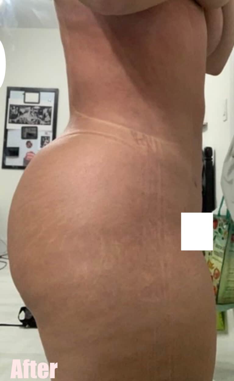 After Image: Brazilian Buttock Lift - right-side