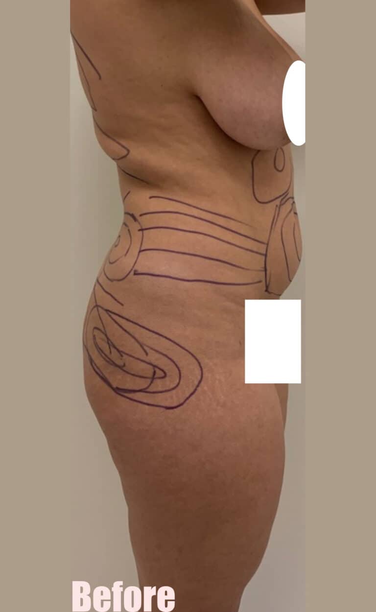Before Image: Brazilian Buttock Lift - right-side