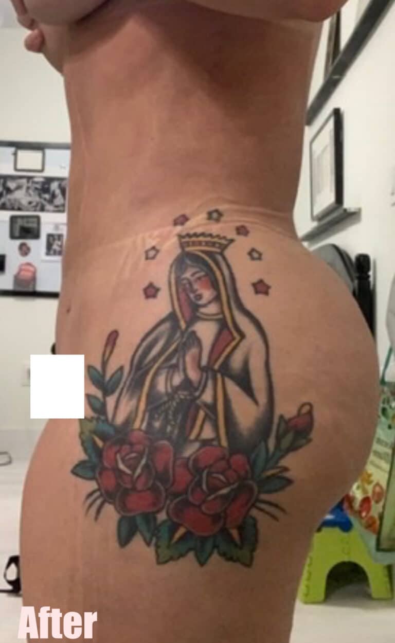 After Image: Brazilian Buttock Lift - left-side
