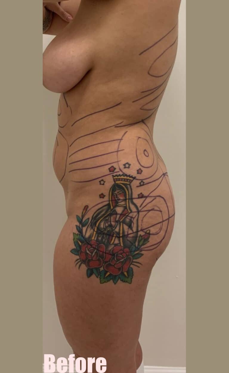 Before Image: Brazilian Buttock Lift - left-side