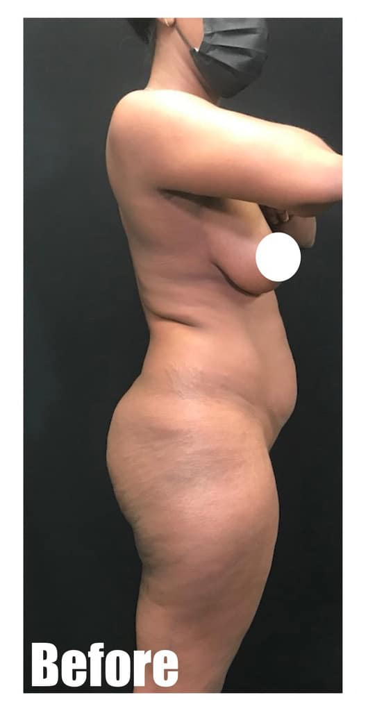 Before Image: Brazilian Buttock Lift -