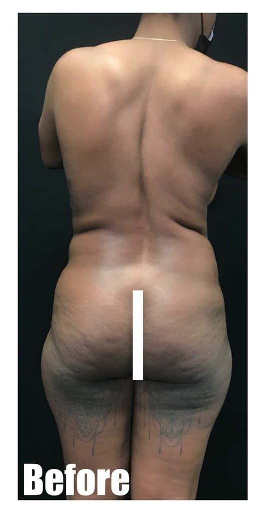 Before Image: Brazilian Buttock Lift - back
