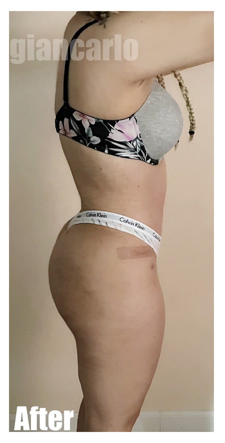After Image: 42 F With BBL and Extended Tummy tuck - front