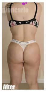 After Image: 42 F With BBL and Extended Tummy tuck