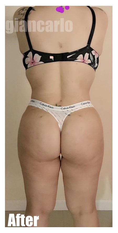 After Image: 42 F With BBL and Extended Tummy tuck - back