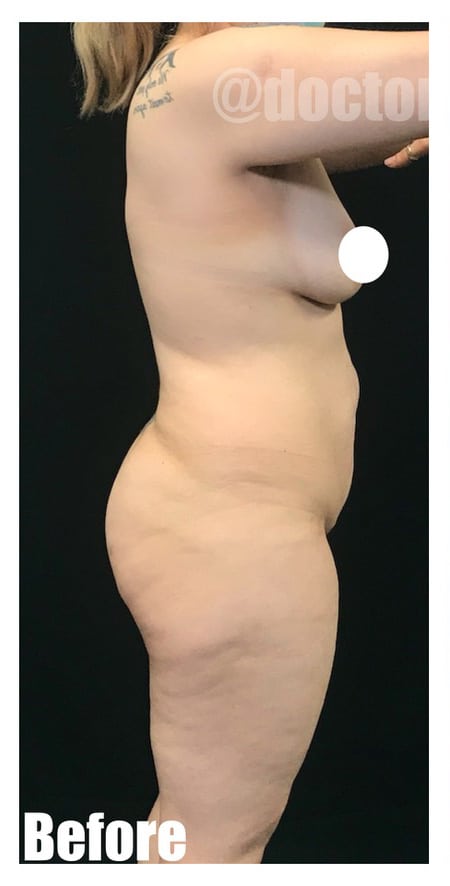 Before Image: 42 F With BBL and Extended Tummy tuck - front
