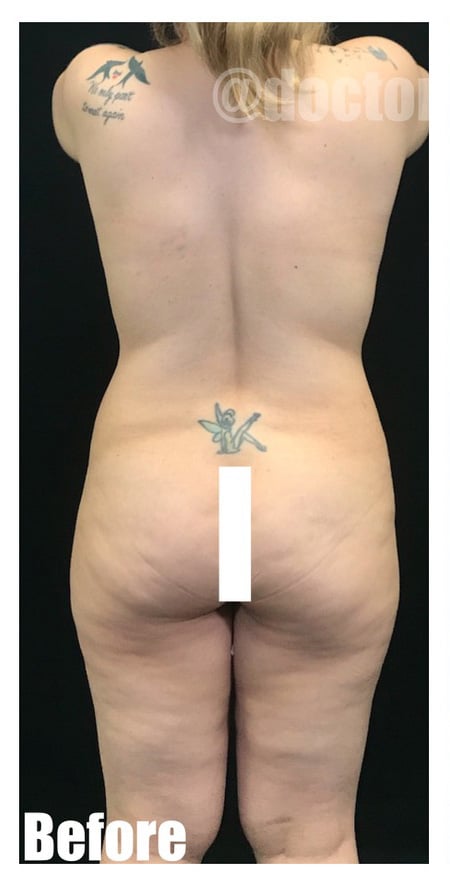 Before Image: 42 F With BBL and Extended Tummy tuck - back
