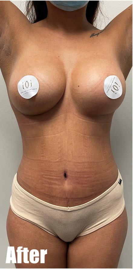 After Image: Breast Augmentation and Tummy Tuck - front