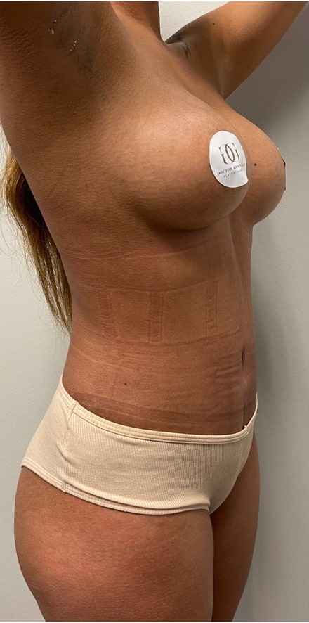After Image: Breast Augmentation and Tummy Tuck - right-front-oblique