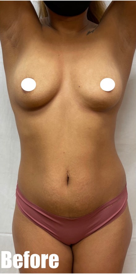 Before Image: Breast Augmentation and Tummy Tuck - front