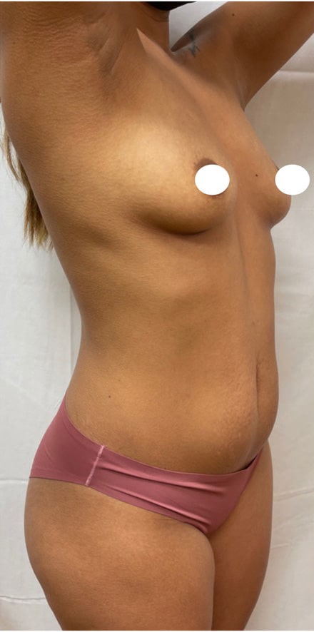 Before Image: Breast Augmentation and Tummy Tuck - right-front-oblique