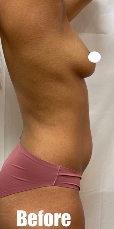 Before Image: Breast Augmentation and Tummy Tuck - right-side