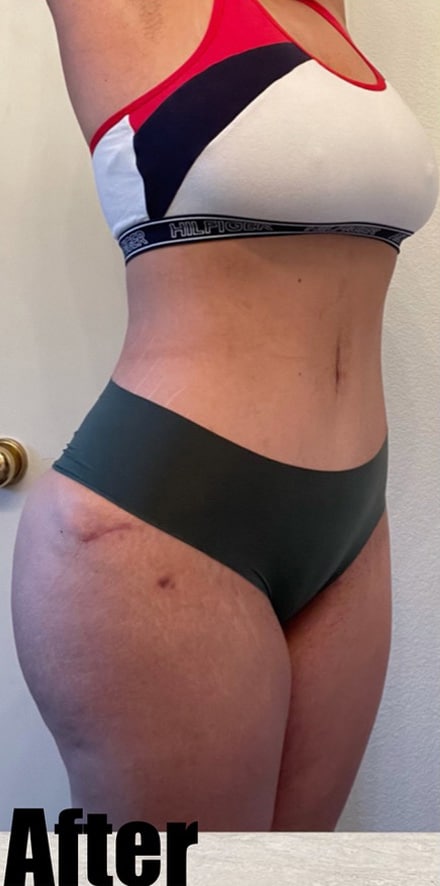 After Image: 39F Brazilian Buttock Lift Extended Tummy Tuck with Breast Lift - right-front-oblique