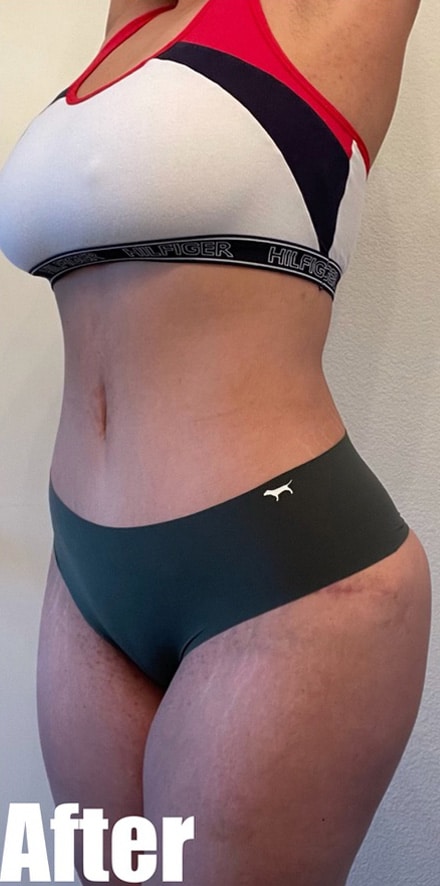 After Image: 39F Brazilian Buttock Lift Extended Tummy Tuck with Breast Lift - left-front-oblique