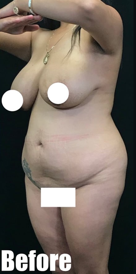 Before Image: 39F Brazilian Buttock Lift Extended Tummy Tuck with Breast Lift - left-front-oblique