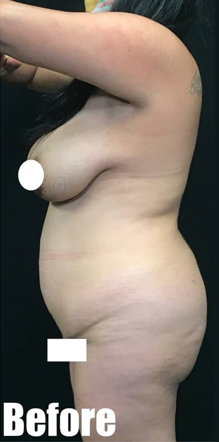 Before Image: 39F Brazilian Buttock Lift Extended Tummy Tuck with Breast Lift - left-side
