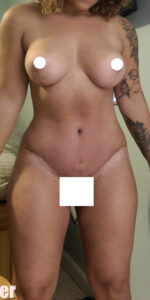 After Image: Tummy Tuck, BBL and Breast Lift with Augmentation