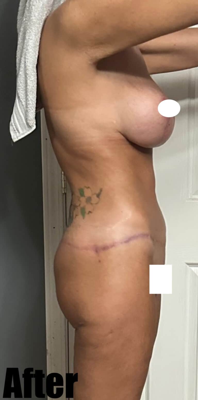 After Image: Thigh Lift and Buttock Lift - right-side
