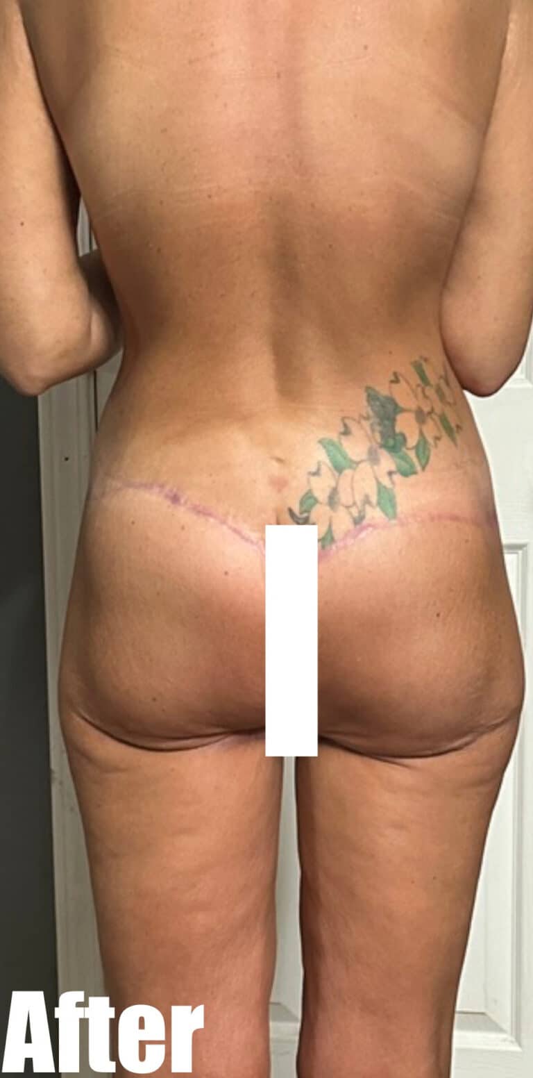 After Image: Thigh Lift and Buttock Lift - back