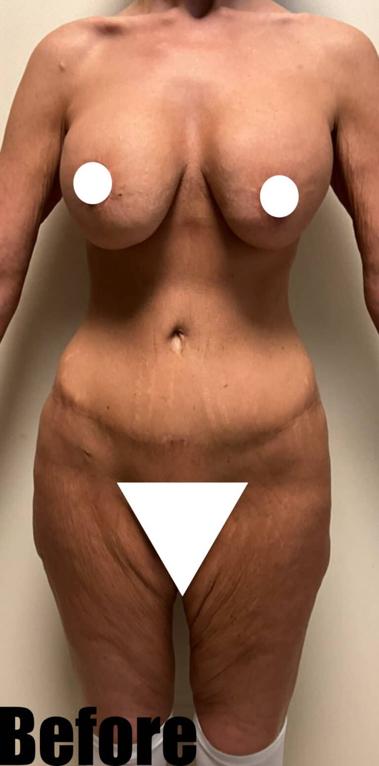Before Image: Thigh Lift and Buttock Lift - front