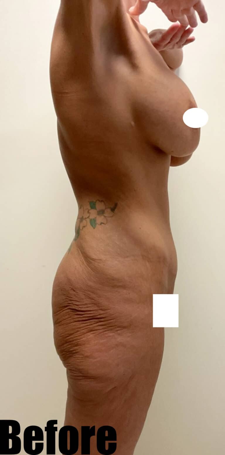 Before Image: Thigh Lift and Buttock Lift - right-side