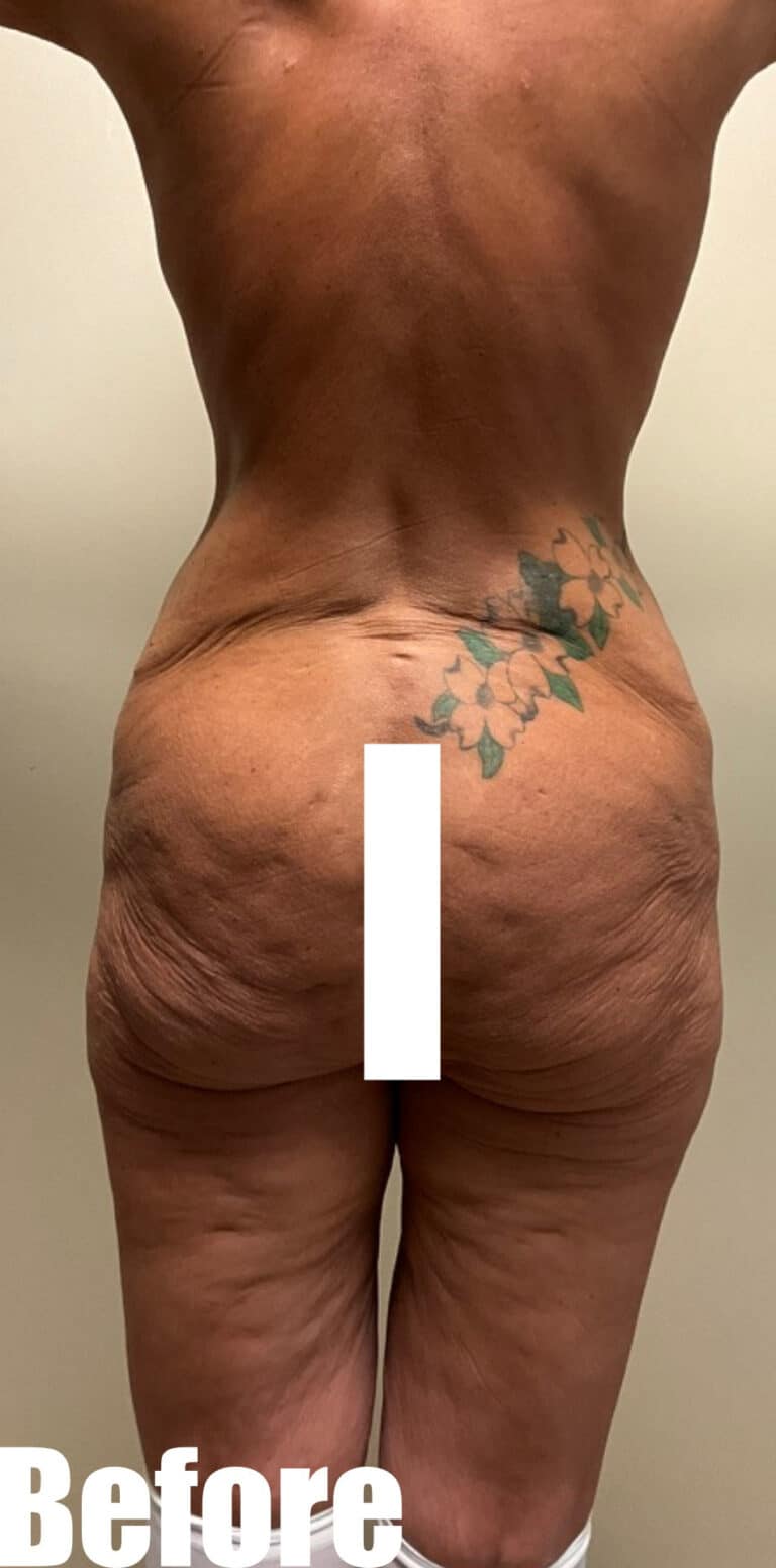 Before Image: Thigh Lift and Buttock Lift - back