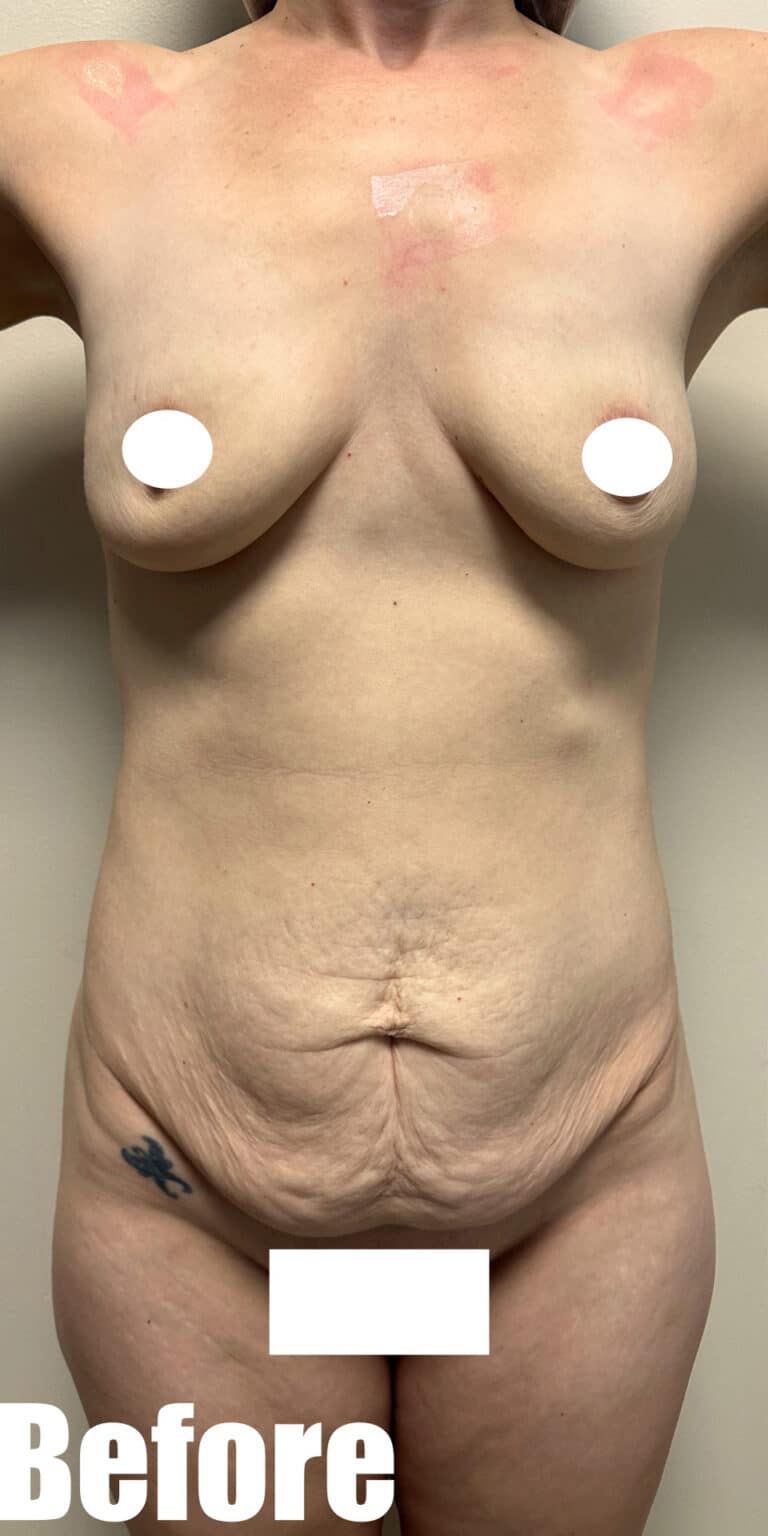 Before Image: Circumferential Mamacita Makeover - front