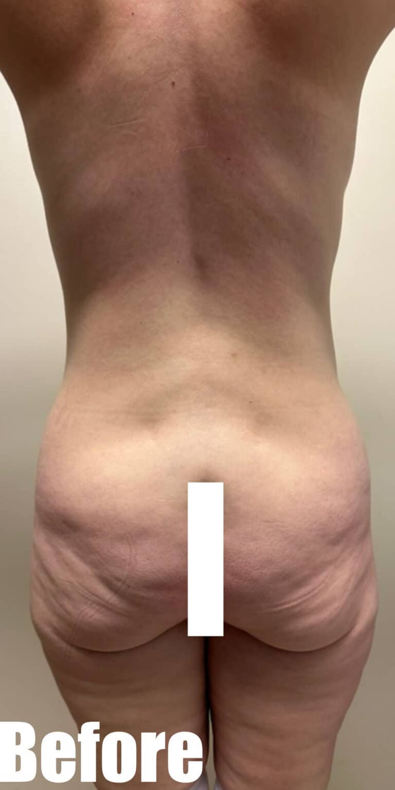 Before Image: Circumferential Mamacita Makeover - back